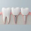 Zirconia Dental Implant