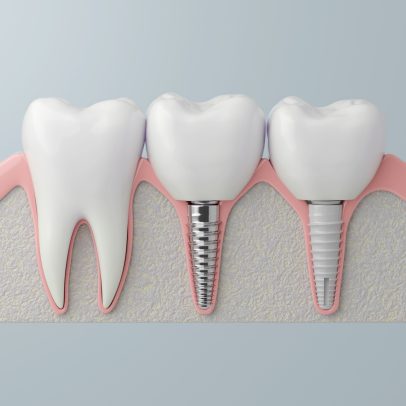 Zirconia Dental Implant
