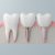 Zirconia Dental Implant