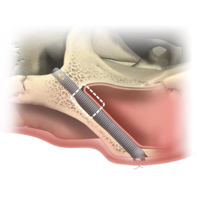 Zygomatic implant placement